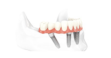 All-on-4 Implant at Dental Fresh