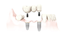 Multiple Implant at Dental Fresh
