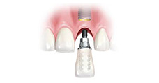 Single Implant at Dental Fresh