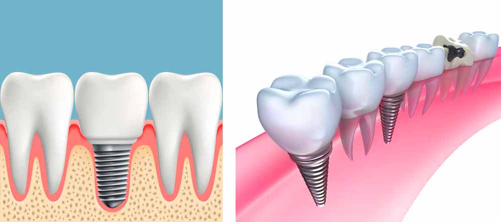 Dental Implants DentalFresh