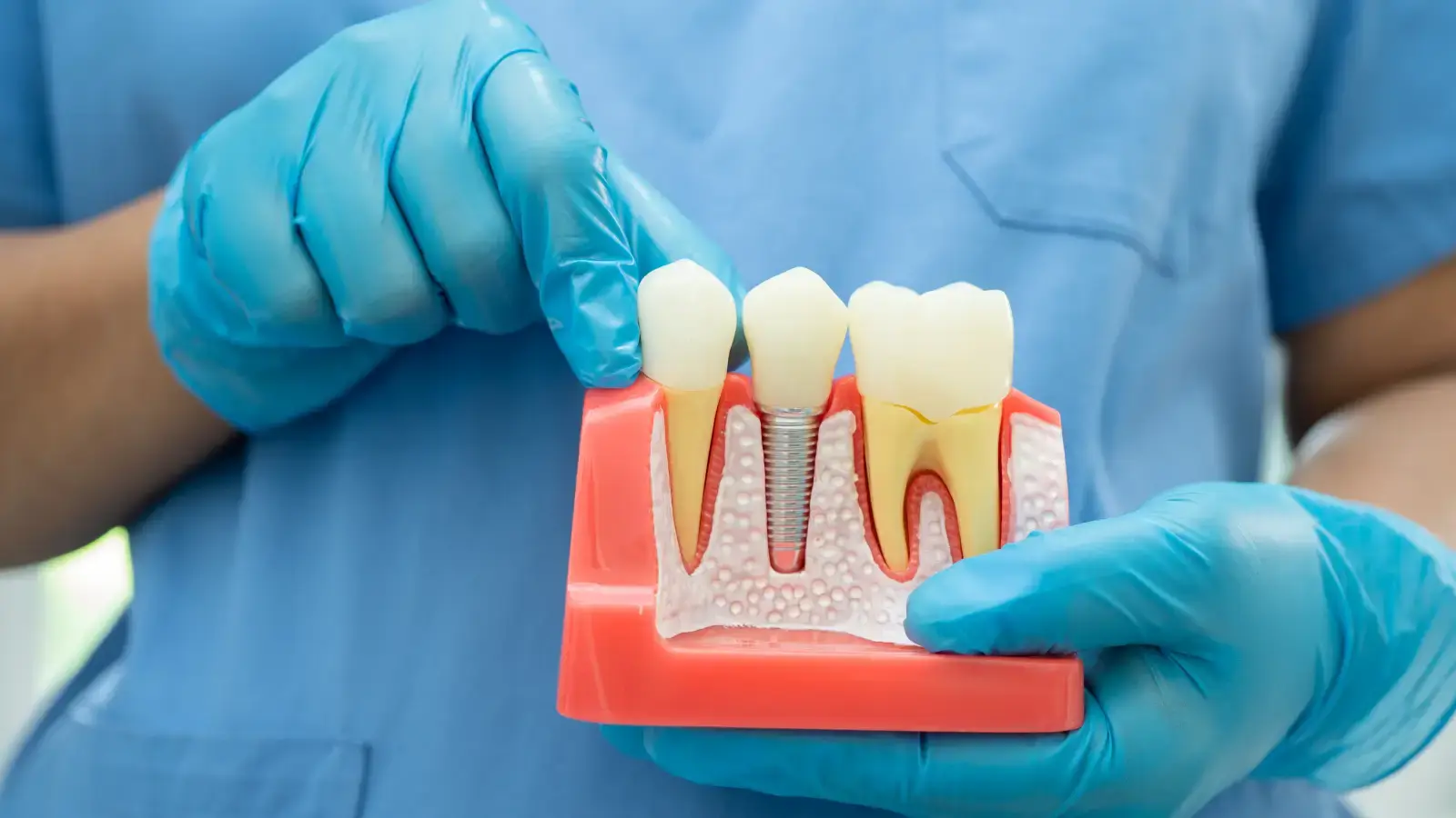 Dentist wearing blue gloves holding a model showing dental implants in Bondi Junction